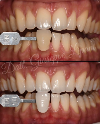 Whitening result