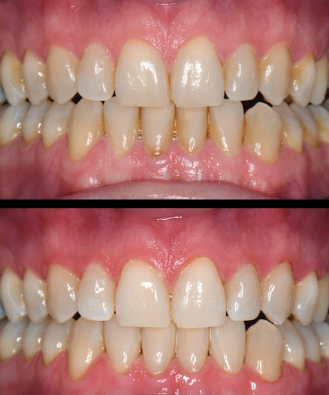 Whitening result