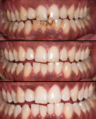 Whitening result